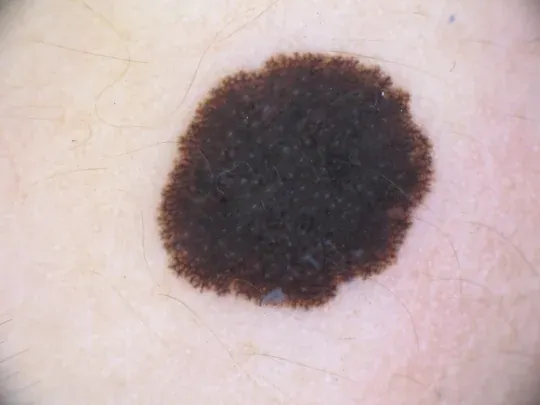 Nevos Melanociticos Congenitos Dra Ana Flavia Moraes