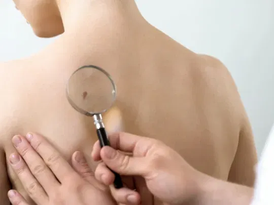 Melanoma Dra Ana Flavia Moraes Dermatologista Vila Mariana SP