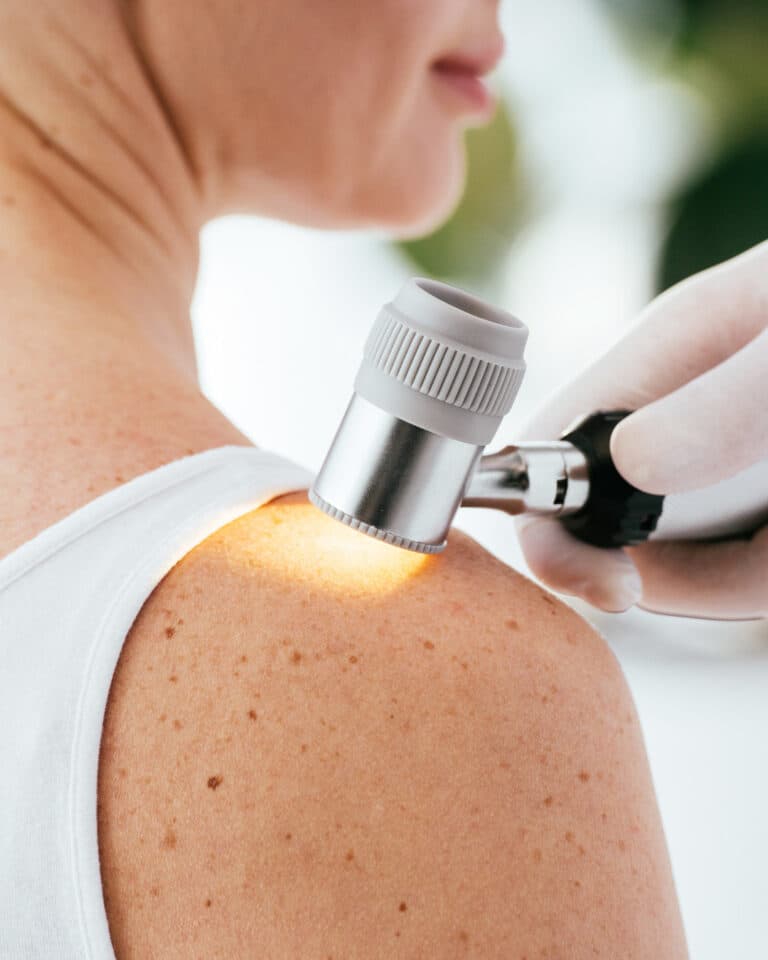 Melanoma Dra Ana Flavia Moraes Dermatologista Sao Paulo