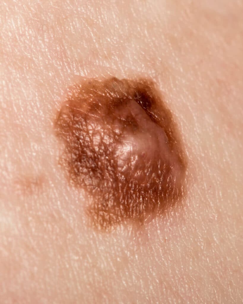 Melanoma O Que é – Dra Ana Flavia Moraes Dermatologista SP